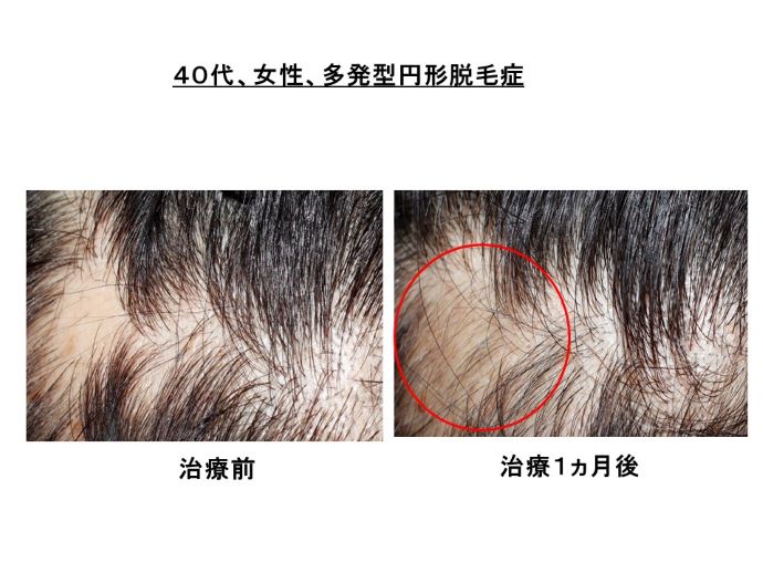 円形脱毛症　病院